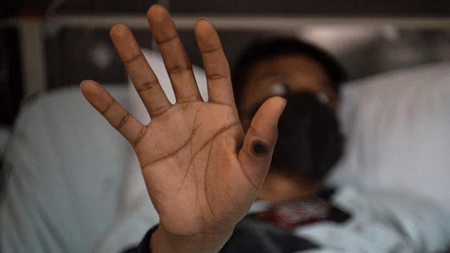 Pakistan reports 7th mpox case