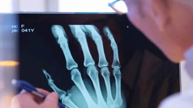 Can AI technology help diagnosing broken bones?