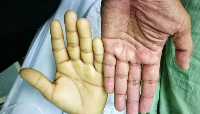 Best foods to remove anemia