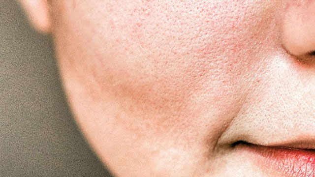 Best home remedies to close facial pores