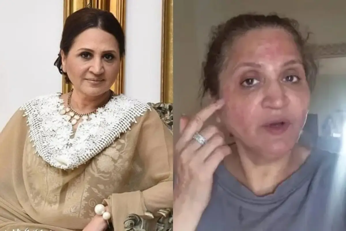 Veteran Actress Asma Abbas Suffers Severe Allergic Reaction to Her Face