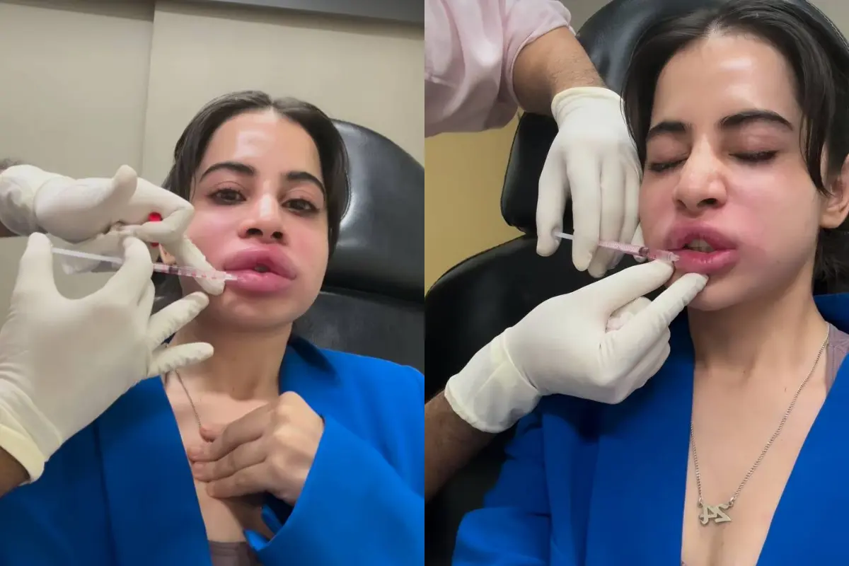 Urfi Javed’s Filler Surgery Sparked Concern Among Fans