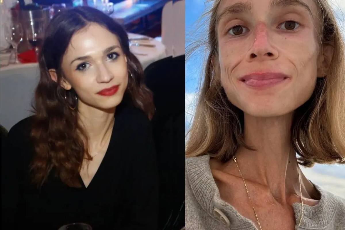 What is Fruitarian Diet? Polish Woman Karolina Krzyzak Dies in Bali After Drastic Weight Loss